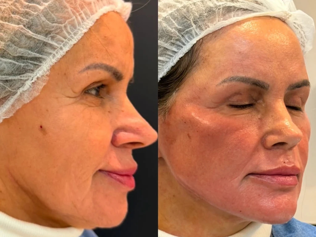 Comparativo antes e depois de tratamento estético facial