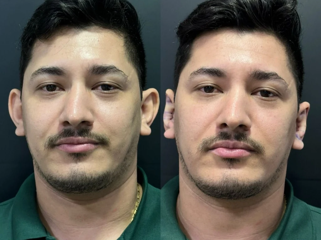 Comparativo antes e depois de procedimento na região das orelhas