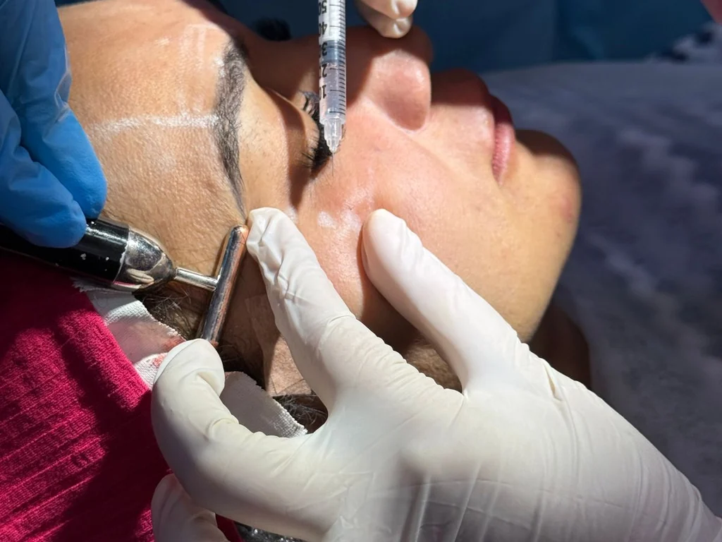 Procedimento estético realizado na região dos olhos