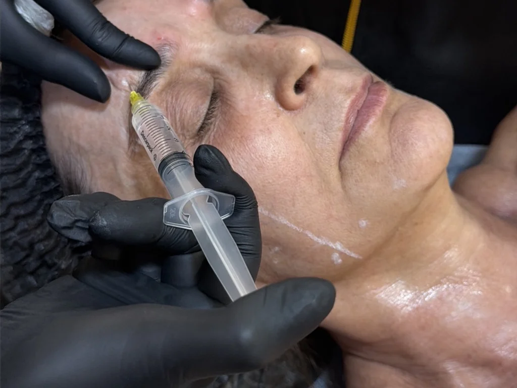 Aplicação de procedimento estético injetável na região facial